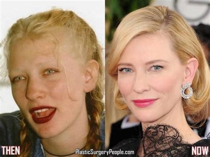 Cate Blanchett Facelift Plastic Surgery Before and After
