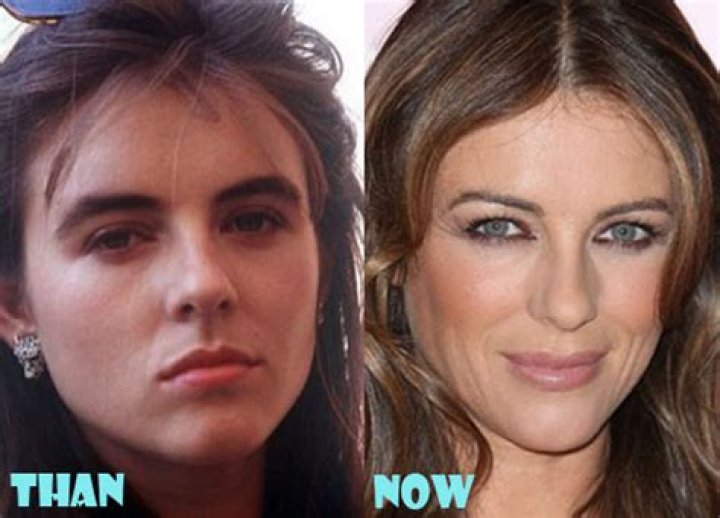 Elizabeth Hurley Plastic Surgery Before and After