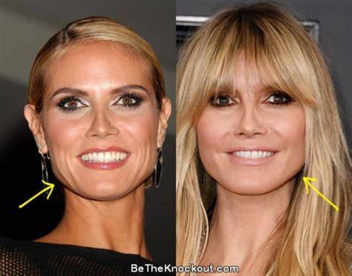 heidi klum plastic surgery