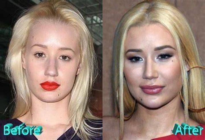 Iggy Azalea Plastic Surgery Before and After