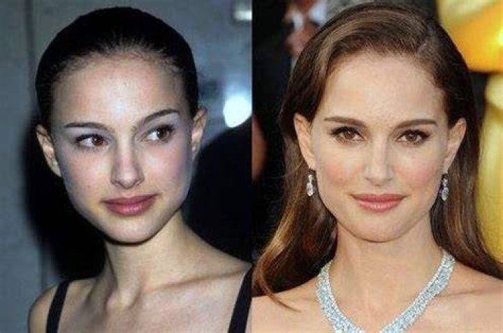Natalie Portman Plastic Surgery Before and After