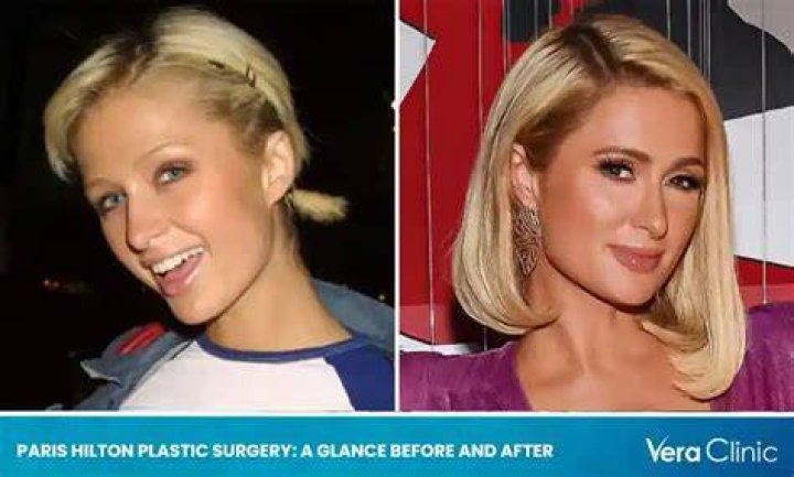 Paris Hilton Plastic Surgery Before and After